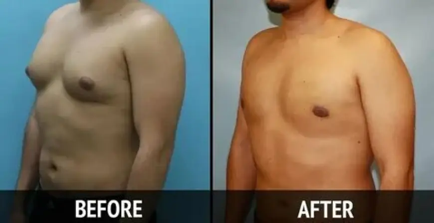 Regain Confidence with Advanced Gynecomastia Treatment in Islamabad