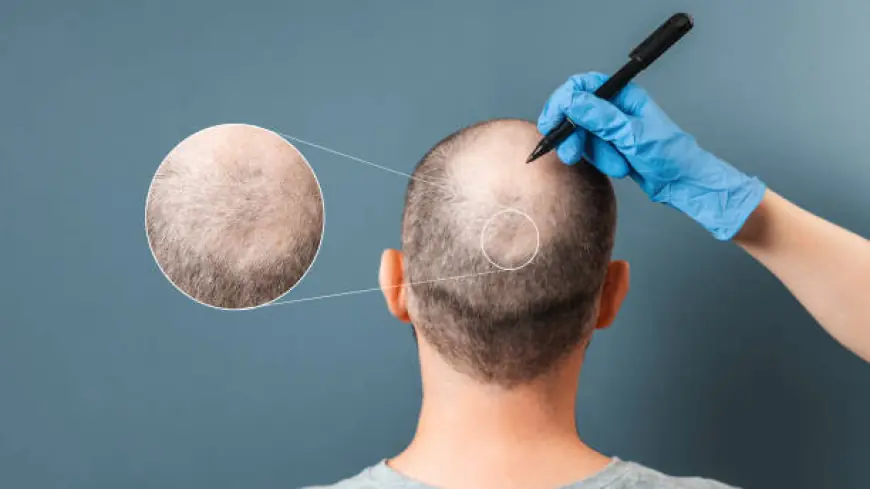 Want Hair Ltd Transforms Lives with Premium UK Hair Transplants