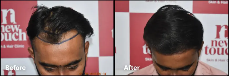How To Find The Best Hair Transplant Clinic In Ahmedabad?