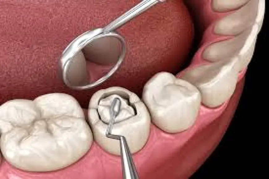 Affordable Dental Tooth Fillings in Islamabad – Restore Your Confidence