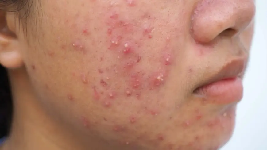 What Is the Best Way to Treat Pimples on Oily Skin?