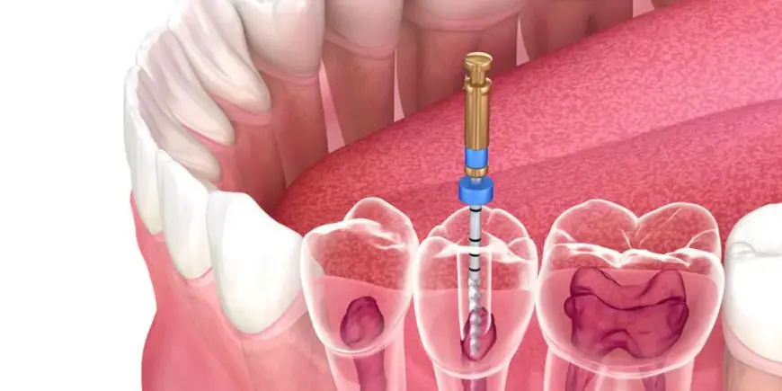 Painless Root Canal Treatment in Islamabad – Advanced Dental Care