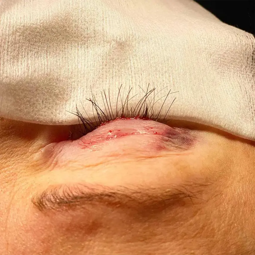 Can Eyelash Hair Transplant Cause Scars Or Marks?