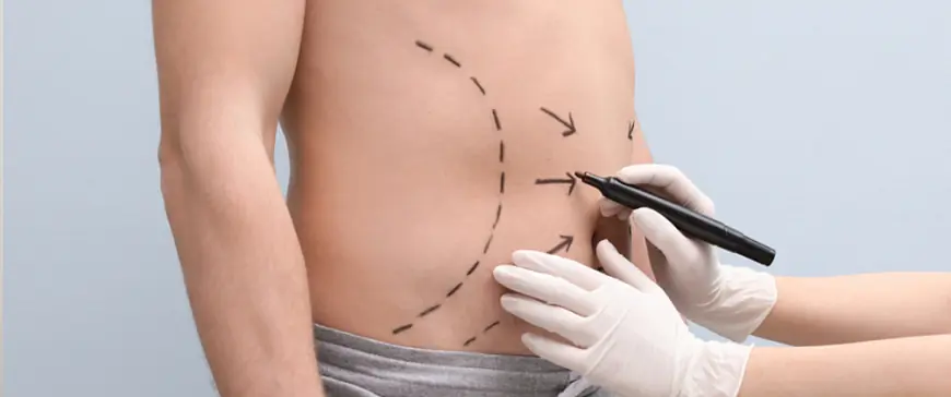 Liposuction Surgery in Dubai, it’s natural to have questions about the procedure, safety, recovery, and results. Dubai’s clinics