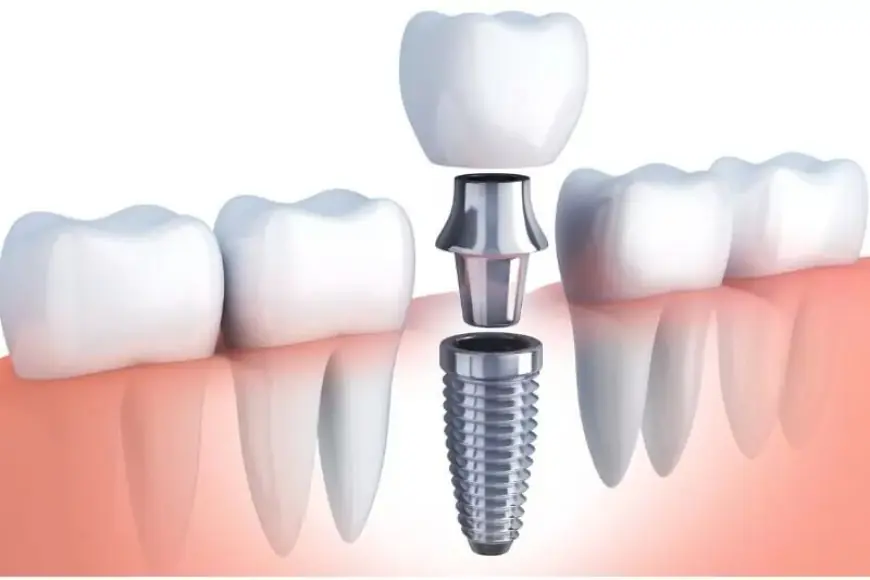 Achieving A Perfect Smile With Dental Implants In London, Ontario