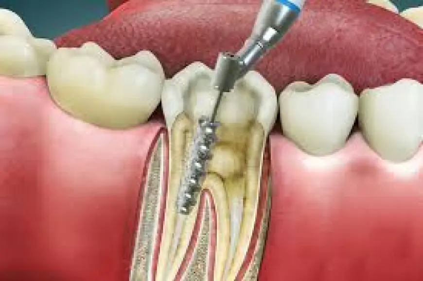 Say Goodbye to Toothache – Root Canal Treatment in Islamabad