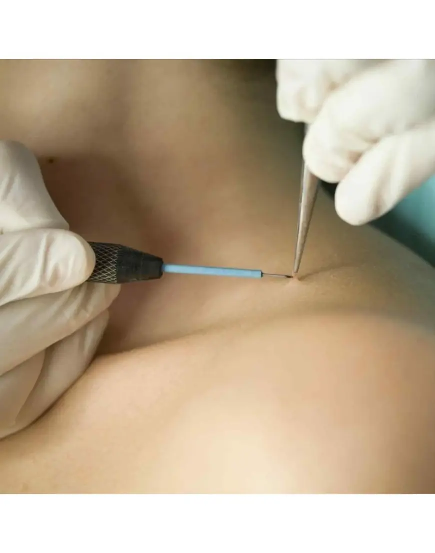 Skin Wart Removal