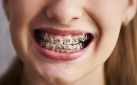 Can Metal Braces Fix Severe Bite Problems Effectively