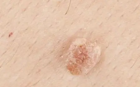 How Does Skin Tag Removal Work?