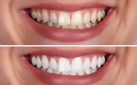Best Teeth Whitening Australia – Brighten Your Smile Today