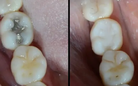 Is Dental Filling in Islamabad the Best Solution to Protect Teeth and Restore Your Smile?