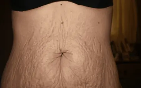 Can a Tummy Tuck Prevent Future Abdominal Sagging?