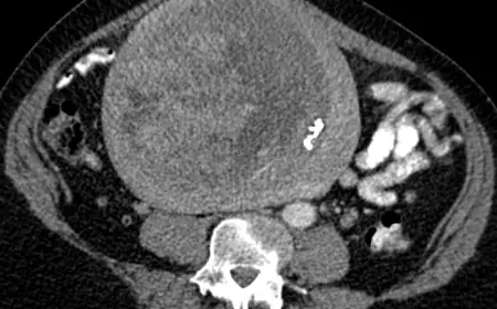 Uterine Fibroid Treatment Market Scope: Exploring Opportunities, Reach, and Potential Growth Globally