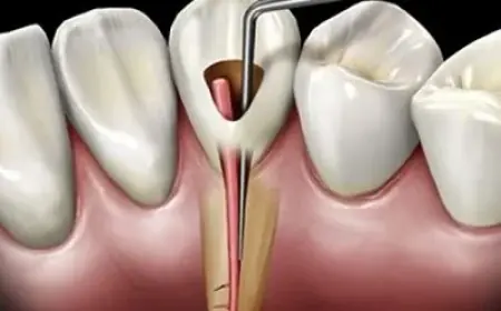 Get Relief from Tooth Pain – Root Canal in Islamabad