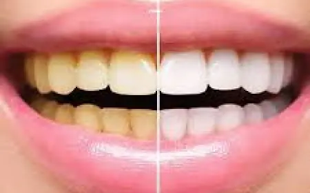 Best Clinics for Teeth Whitening in Islamabad – Book Now