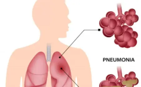 Pneumonia vs. Common Cold: How to Spot the Difference Early