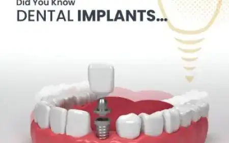 Top Clinics for Dental Implants in Islamabad – Book Now