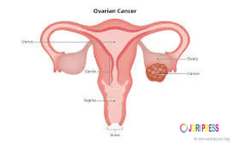 Ovarian Cancer Treatment Cost in India – A Complete Guide to Affordable Care
