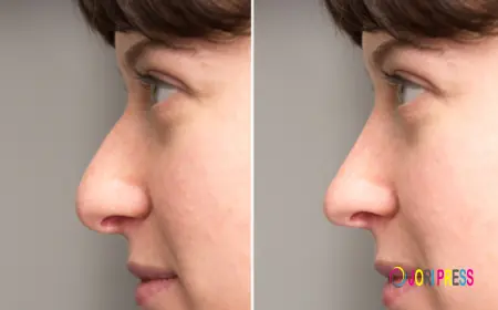 Expert Guide to Revision Rhinoplasty Procedures in Riyadh