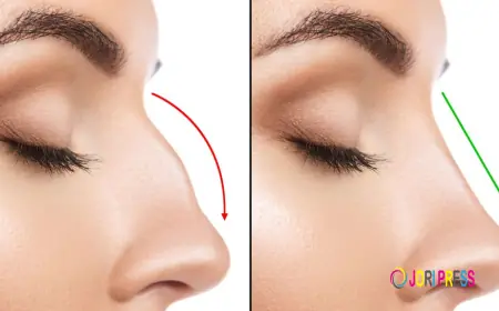 Revision Rhinoplasty in Riyadh: Correcting Past Surgeries