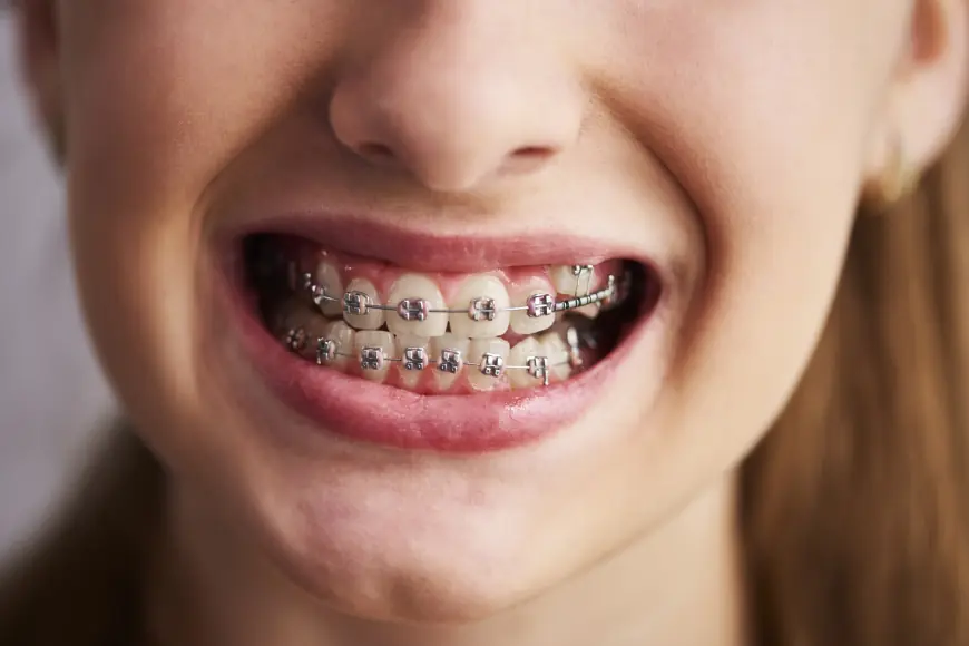 Can Metal Braces Fix Severe Bite Problems Effectively