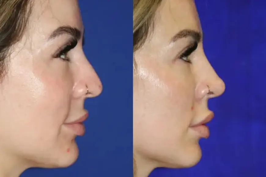 Reshape Your Nose Without Surgery: Liquid Rhinoplasty Treatment in Islamabad