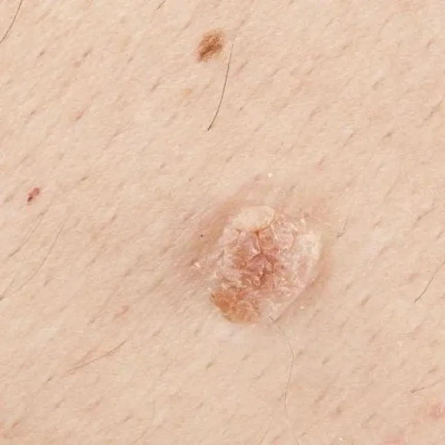How Does Skin Tag Removal Work?