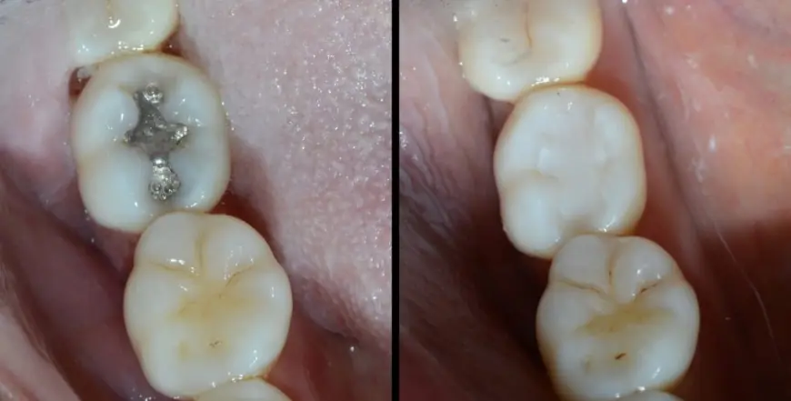 Is Dental Filling in Islamabad the Best Solution to Protect Teeth and Restore Your Smile?