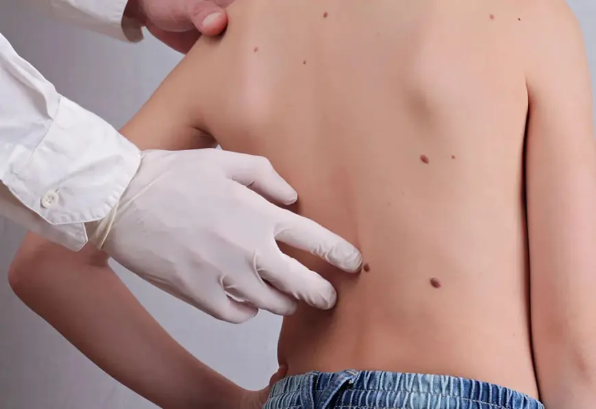 Is Skin Tag Removal Recommended for Children?