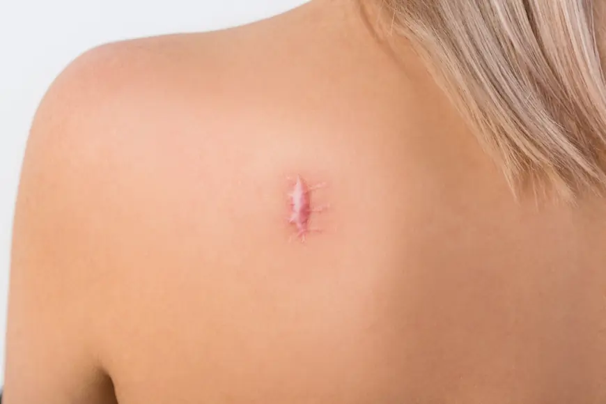 Laser Scar Removal vs. Traditional Treatments: Which Is More Effective?