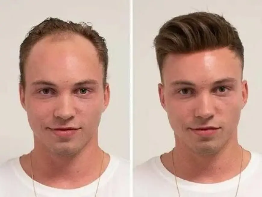 Hair Transplant in Islamabad – Natural Hair Restoration for Lasting Confidence