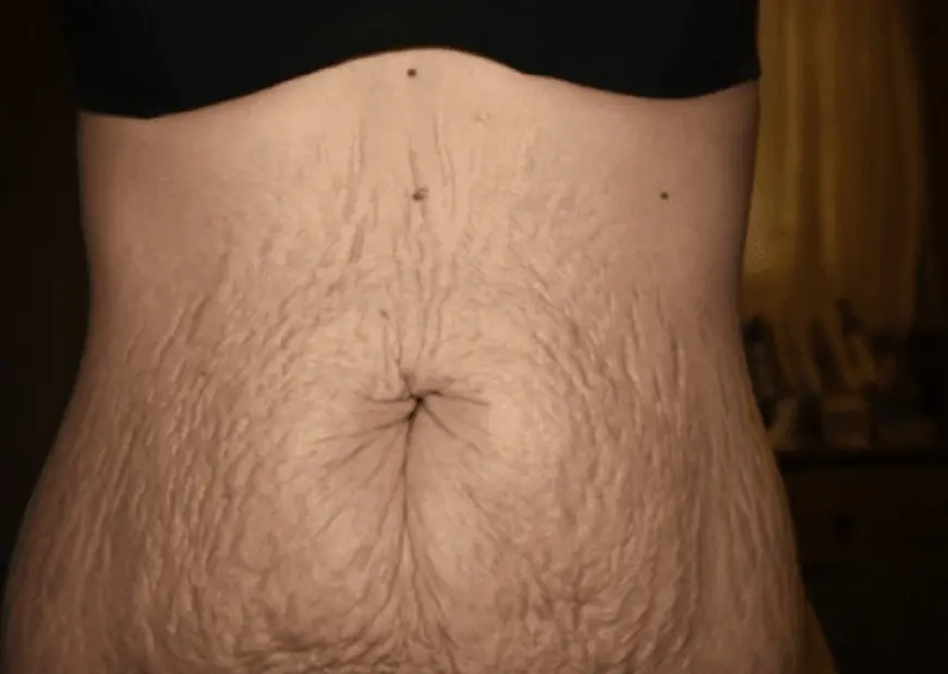 Can a Tummy Tuck Prevent Future Abdominal Sagging?