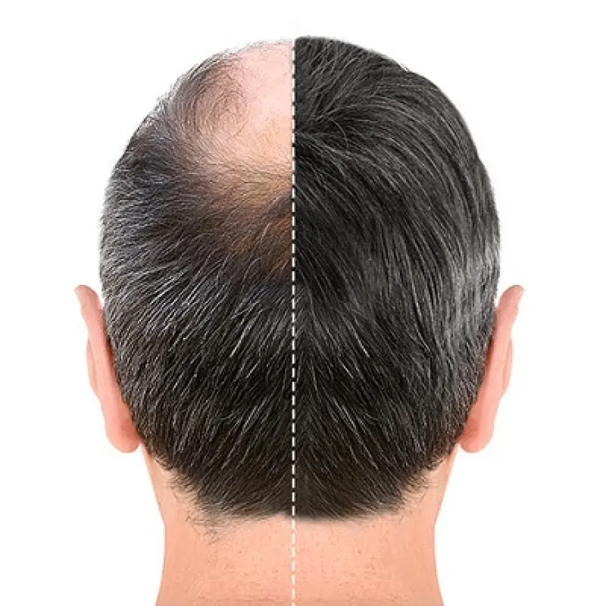 Hair Transplant in Dubai for Different Age Groups: Is It Right for You?