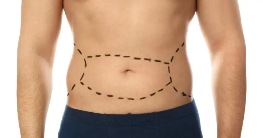 Does a Tummy Tuck Improve Overall Posture Too?