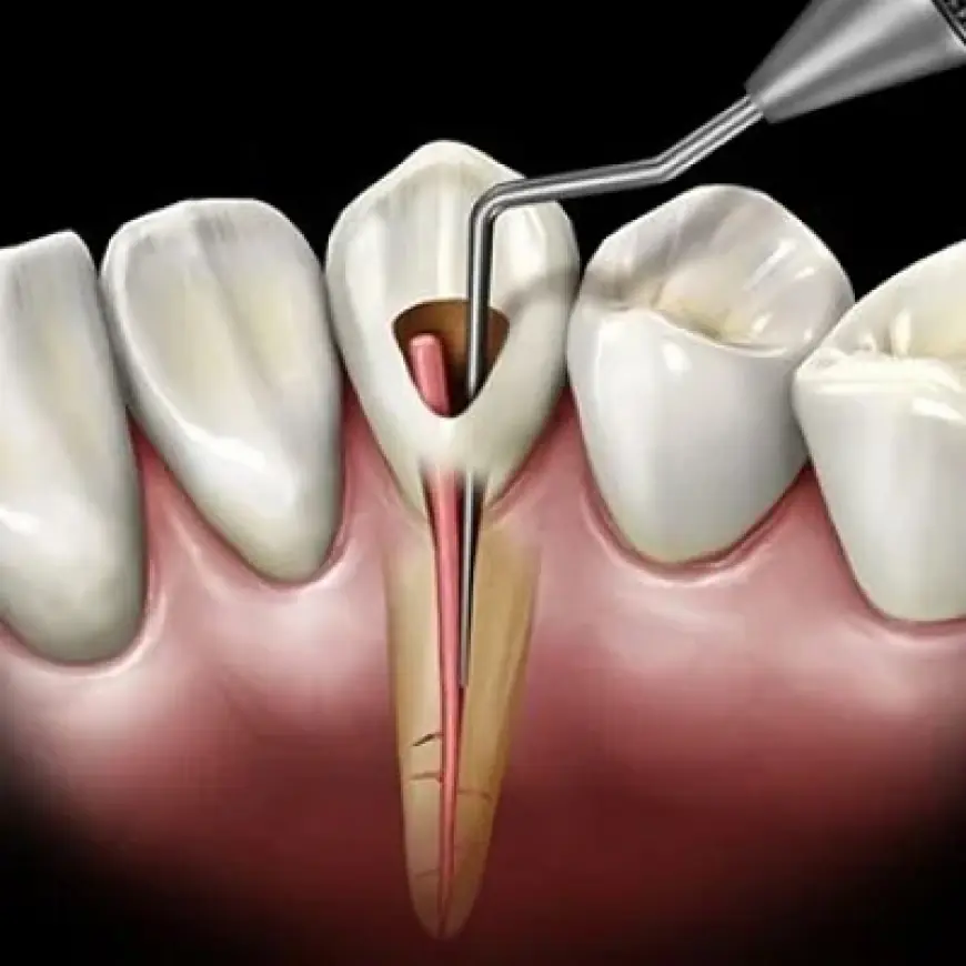 Get Relief from Tooth Pain – Root Canal in Islamabad