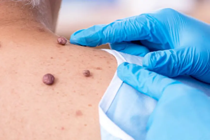 What Is the Best Way to Remove a Mole?