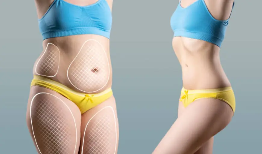 Tummy Tuck Surgery and Muscle Repair: What You Need to Know