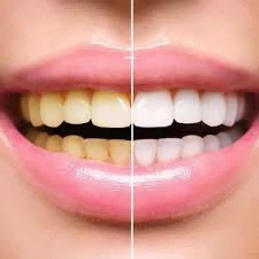 Best Clinics for Teeth Whitening in Islamabad – Book Now