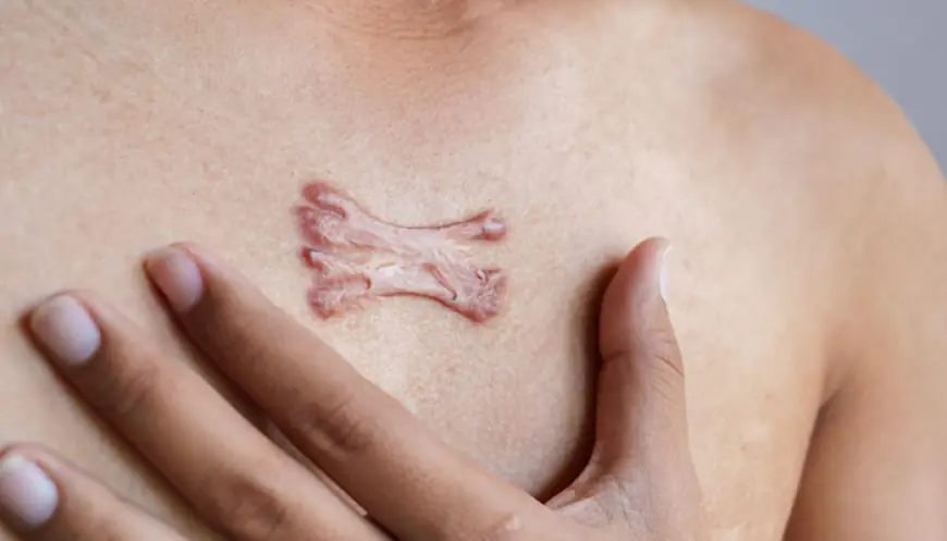 Keloid Removal Cost in Islamabad – What to Expect