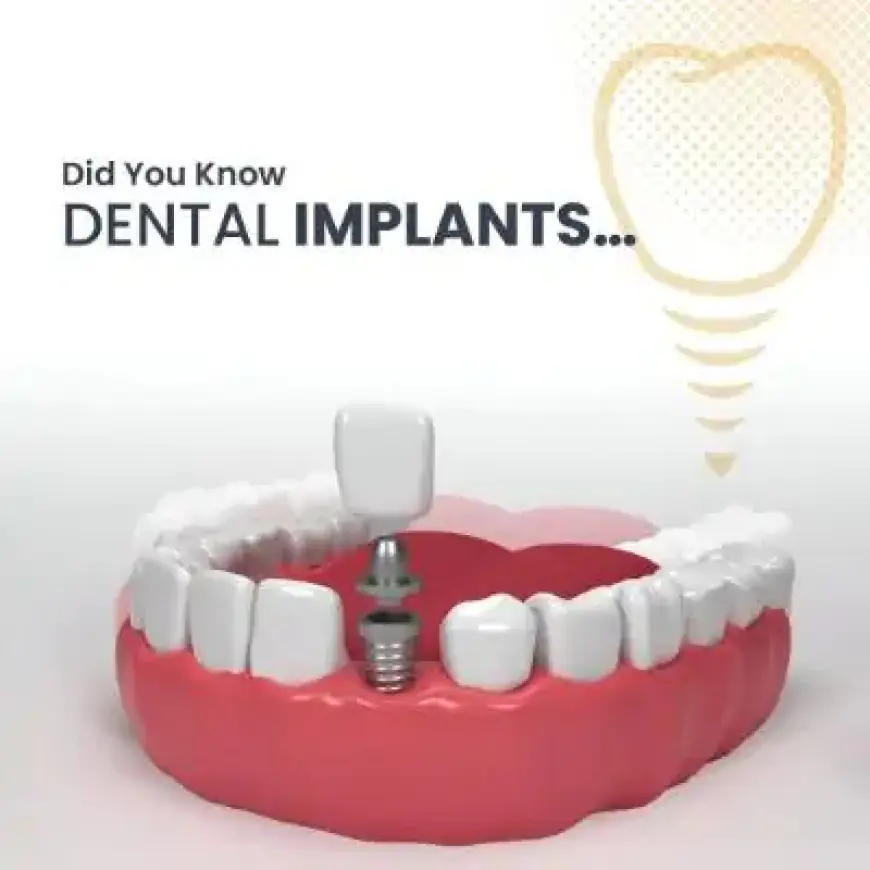 Top Clinics for Dental Implants in Islamabad – Book Now