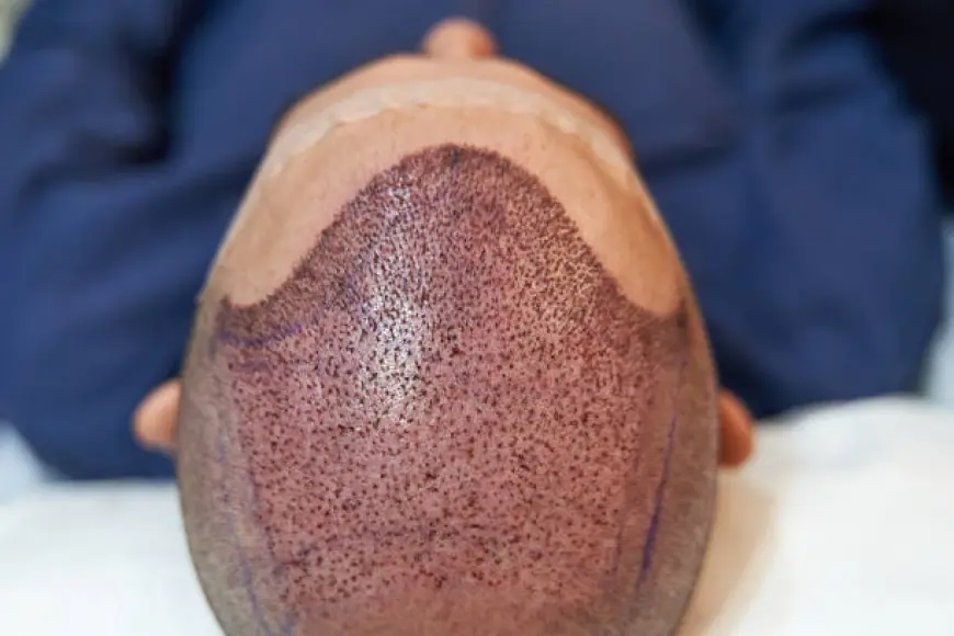 Advanced Hair Transplant Techniques Riyadh