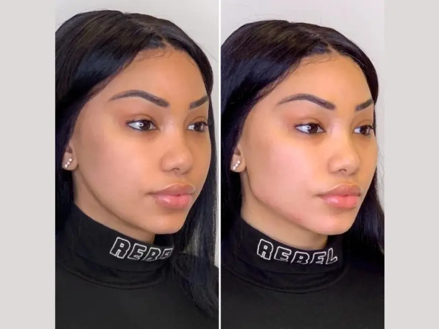 Restore Natural Beauty at Best Aesthetic Clinic in Dubai with Expert Thread Lift