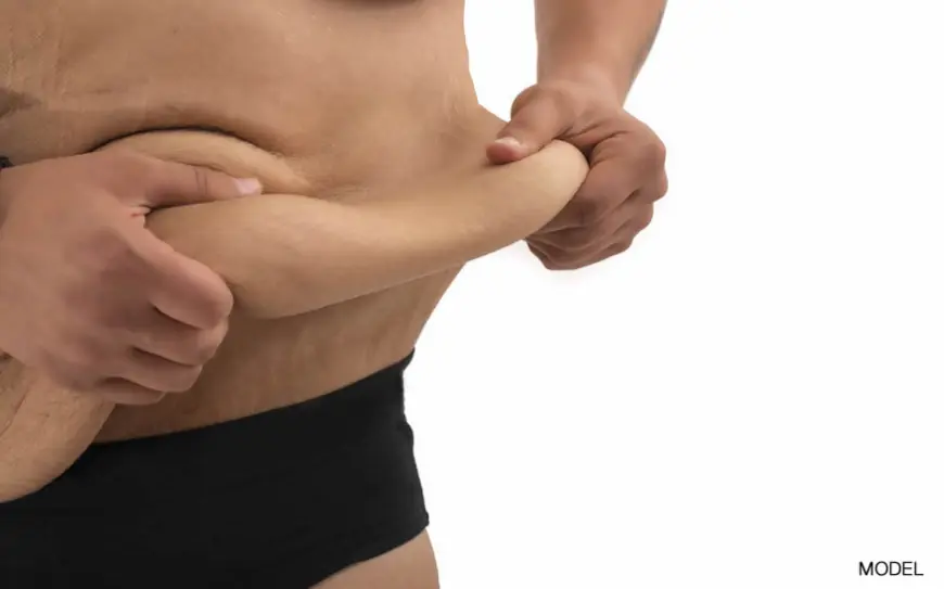 Is Lipo Abdominoplasty Right for You? Key Factors to Consider