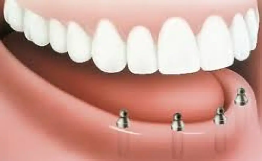 Dental Implants in Islamabad – Permanent Solution for Missing Teeth