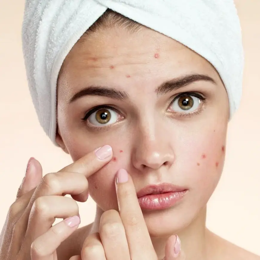 Riyadh’s Best Acne Treatment for Clear Skin