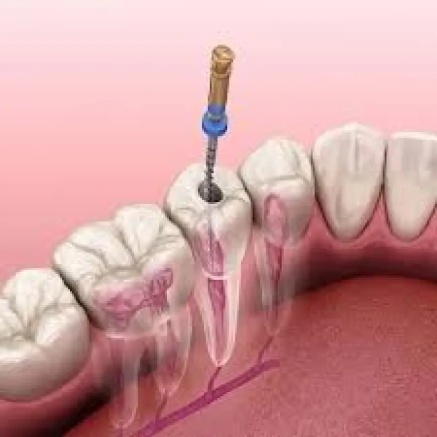 Affordable Root Canal Treatment in Islamabad – Restore Oral Health
