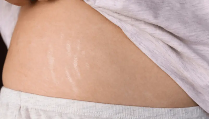 Is Microneedling Good for Stretch Marks?