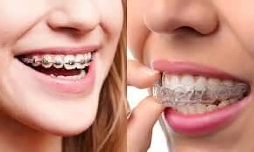 Affordable Aligners in Islamabad – Perfect Smile Made Easy