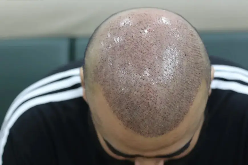Uncover the Benefits of Hair Transplants in Dubai