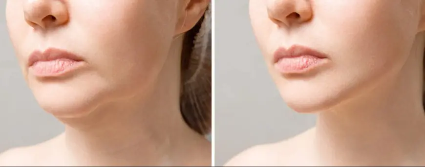 How to Get Rid of a Double Chin in Islamabad